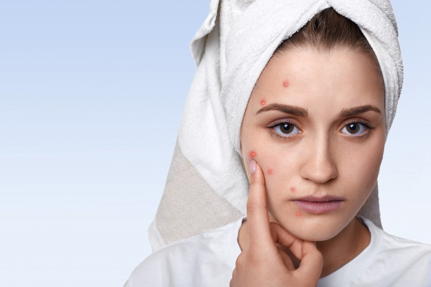 portrait-young-woman-having-problem-skin-pimple-her-cheek-wearing-towel-her-head-having-sad-expression-pointing_176532-9979