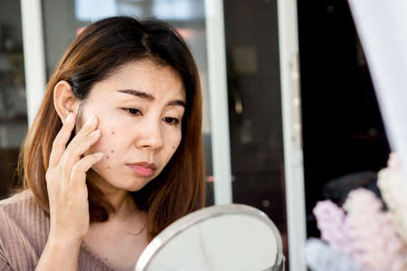 161122361-asian-woman-checking-her-face-skin-problem-with-acne-scar-dark-spot-on-mirror